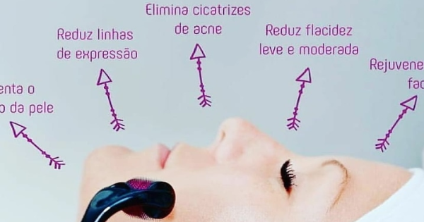 Microagulhamento